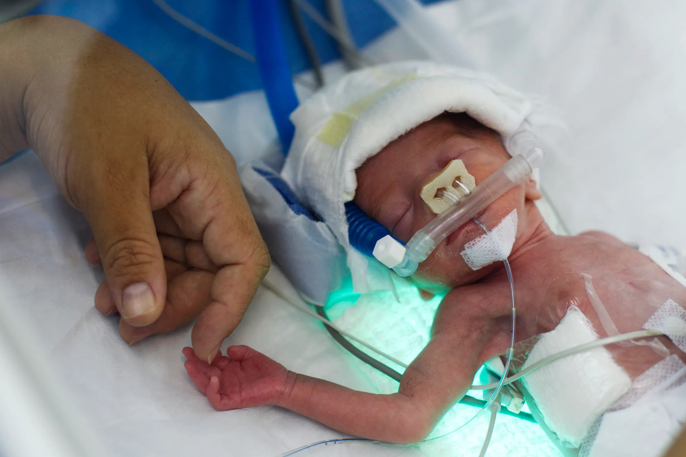 Dealing with Premature Baby Development Problems