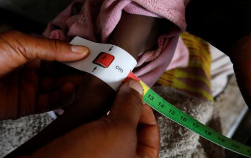 A severely acute malnourished and internally displaced Congolese child is screened at the Tshiamala general referral hospital of Mwene Ditu in Kasai Oriental Province in the Democratic Republic of Congo, March 15, 2018. Picture taken March 15, 2018. REUTERS/Thomas Mukoya - RC1D8FC05450