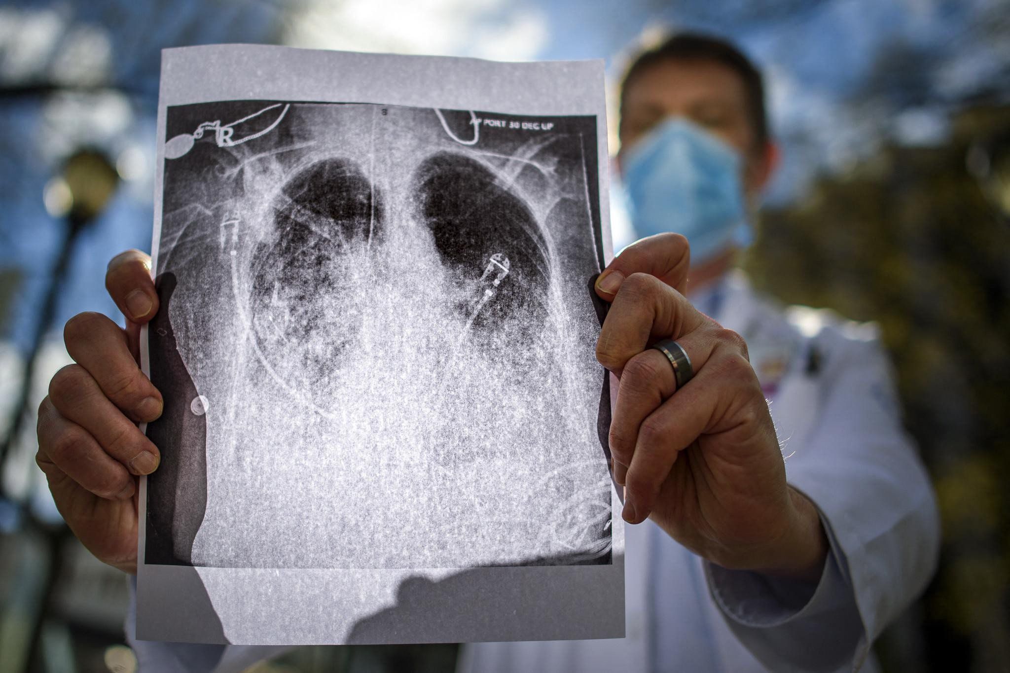 A physician holds a printed X-ray illustrating double lung pneumonia typical in COVID-19 patients.